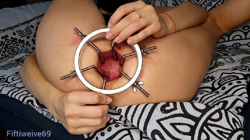 Anal Dilator In Action